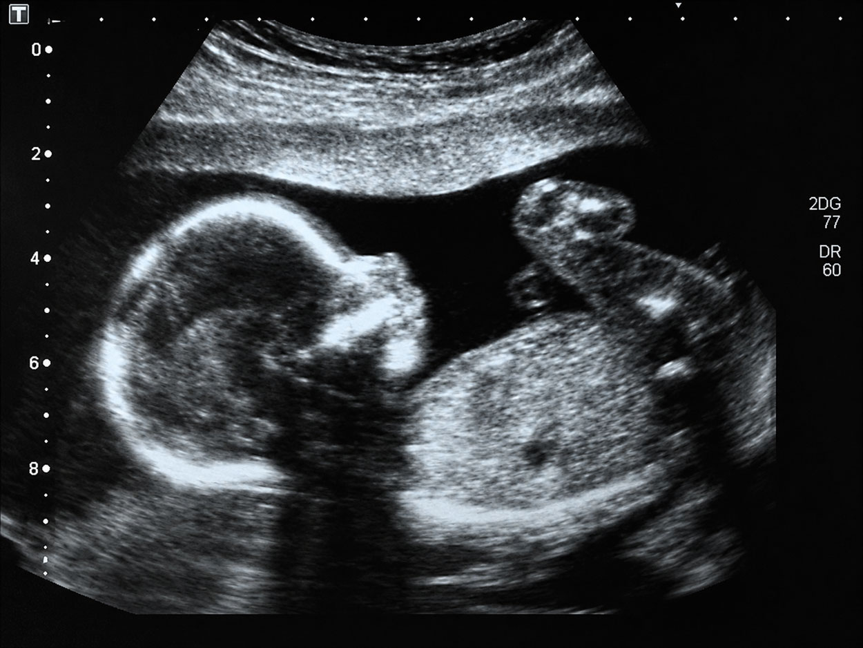 Pregnancy ultrasound showing a developing fetus