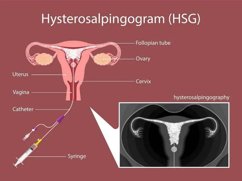 Hysterosalpingogram diagram showing the uterus, fallopian tubes, catheter, and syringe